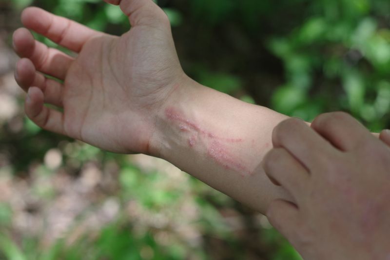 Poison Ivy Relief